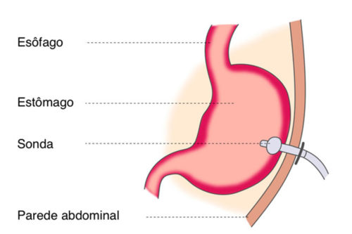 gastrostomia