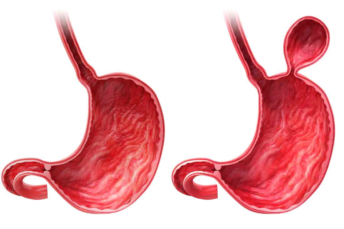 Conheça a melhor forma de prevenir as hérnias abdominais